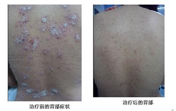 重庆治疗牛皮癣案例图,牛皮癣症状,牛皮癣偏方,牛皮癣治疗效果图