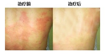 荨麻疹案例,荨麻疹病因,荨麻疹治疗方法_重庆荨麻疹医院